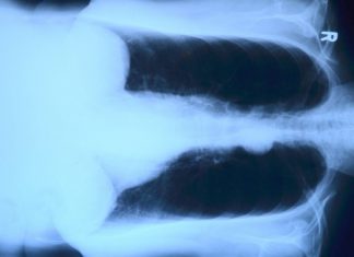 Associations Between Tuberculosis Risk And Variants Of Diabetes