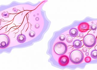 PALB2 May Be A Risk Locus For Ovarian Cancer