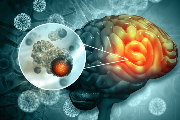 RENACER-World's-First-Biobank-of-Brain-Metastasis-Living-Samples RENACER: World's First Biobank of Brain Metastasis Living Samples